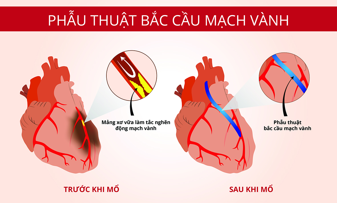 Sửa chữa trái tim thương tổn của người đàn ông