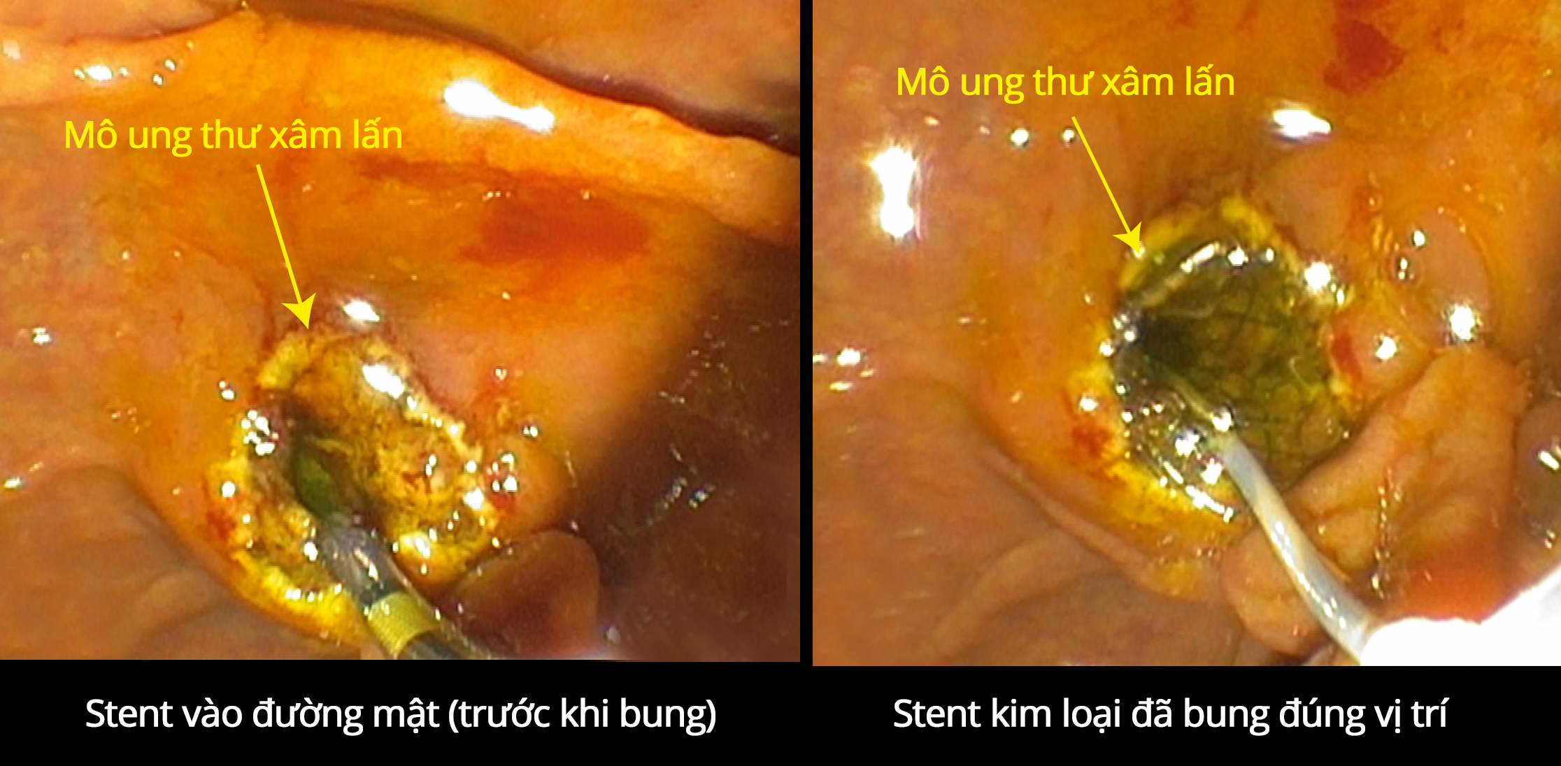 Cứu sống cụ bà bị ung thư tụy xâm lấn gây tắc mật