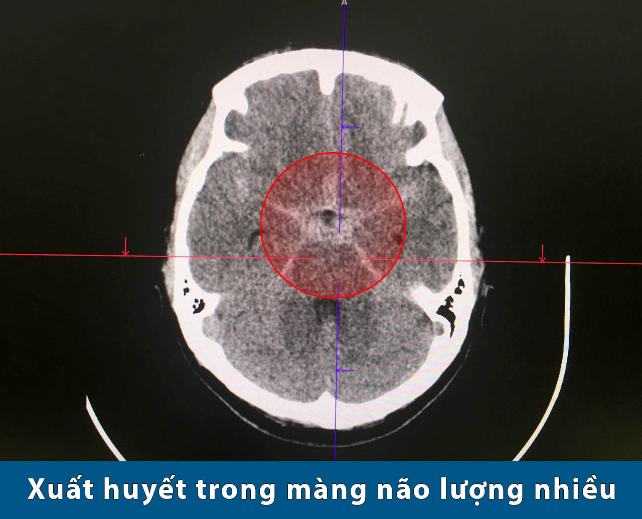 Cứu sống nữ bệnh nhân bị xuất huyết màng não sau cơn đau đầu dữ ...