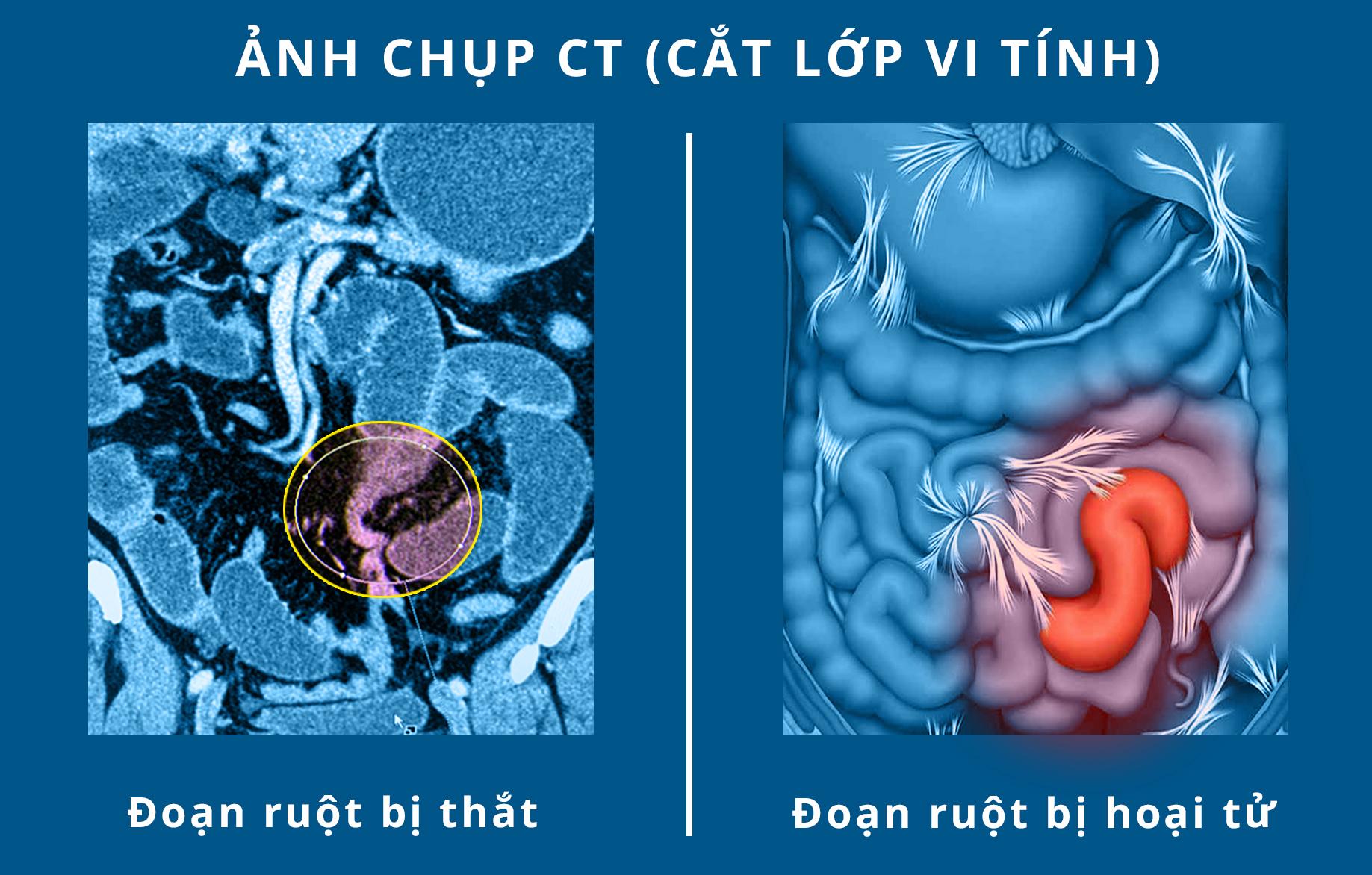 Hoại tử ruột qua ảnh chụp CT