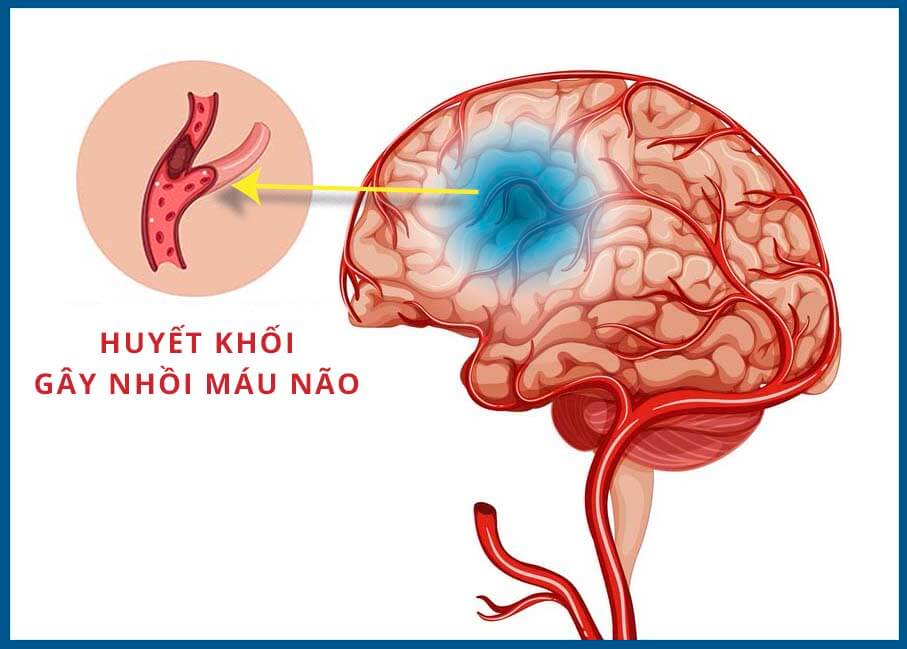 Cứu sống kịp thời một phụ nữ bị đột quỵ não cấp khi đang phơi quần áo