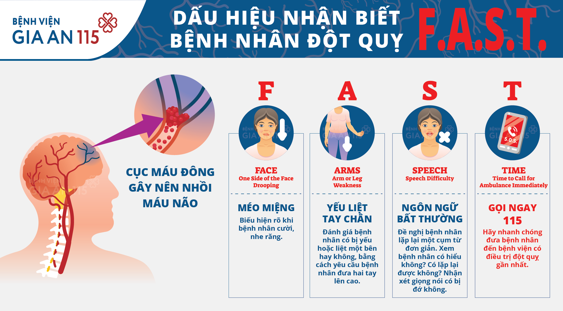 Triệu chứng đột quỵ thoáng qua: Dấu hiệu cần biết để phòng tránh hiệu quả