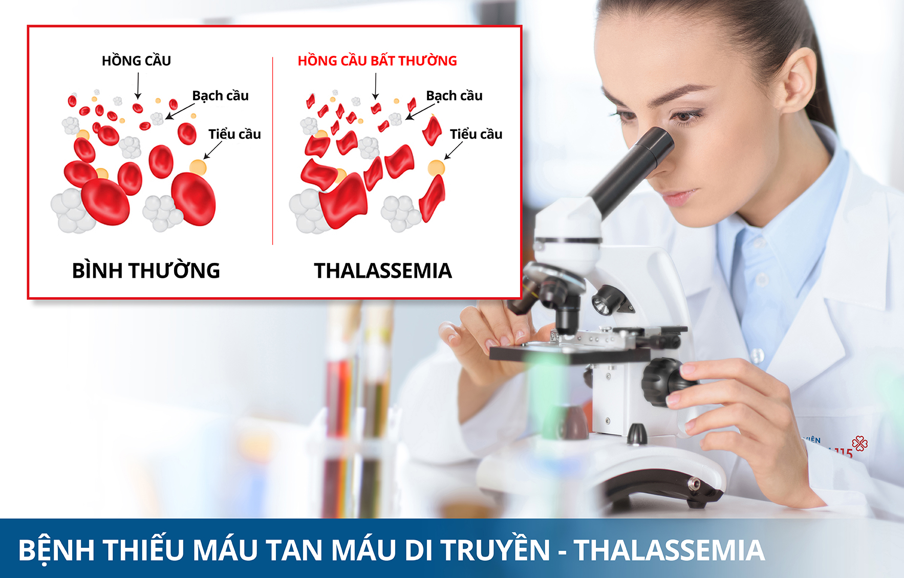 Thiếu máu, thừa sắt - có thể do căn bệnh di truyền tán huyết bẩm sinh