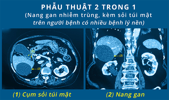 Đại phẫu thành công, cứu sống cụ bà 85 tuổi nhiễm trùng nang gan, sỏi túi mật với nhiều bệnh lý nền