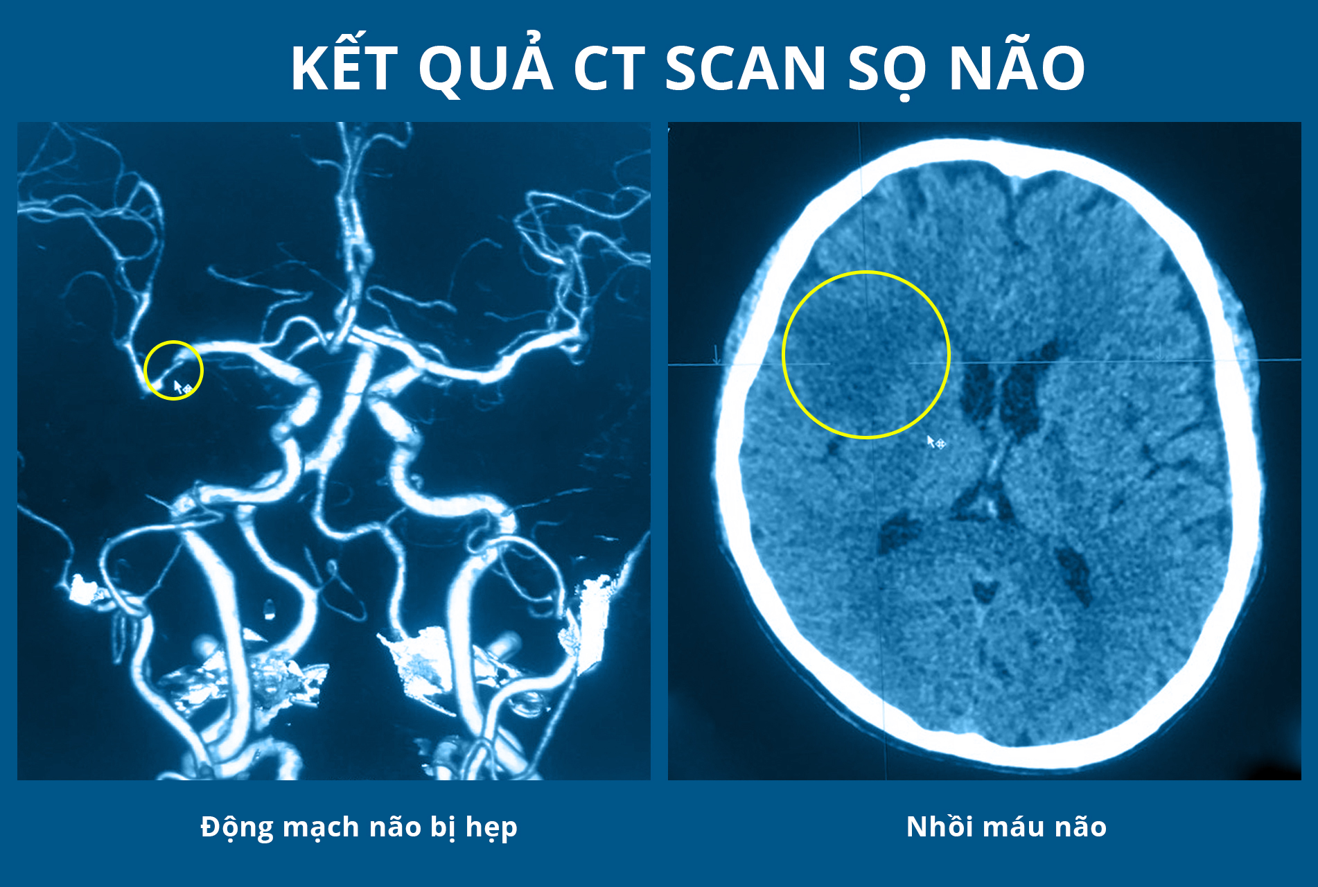 Điều trị tiêu sợi huyết đường động mạch cứu người bệnh đột quỵ đến sau “giờ vàng” 