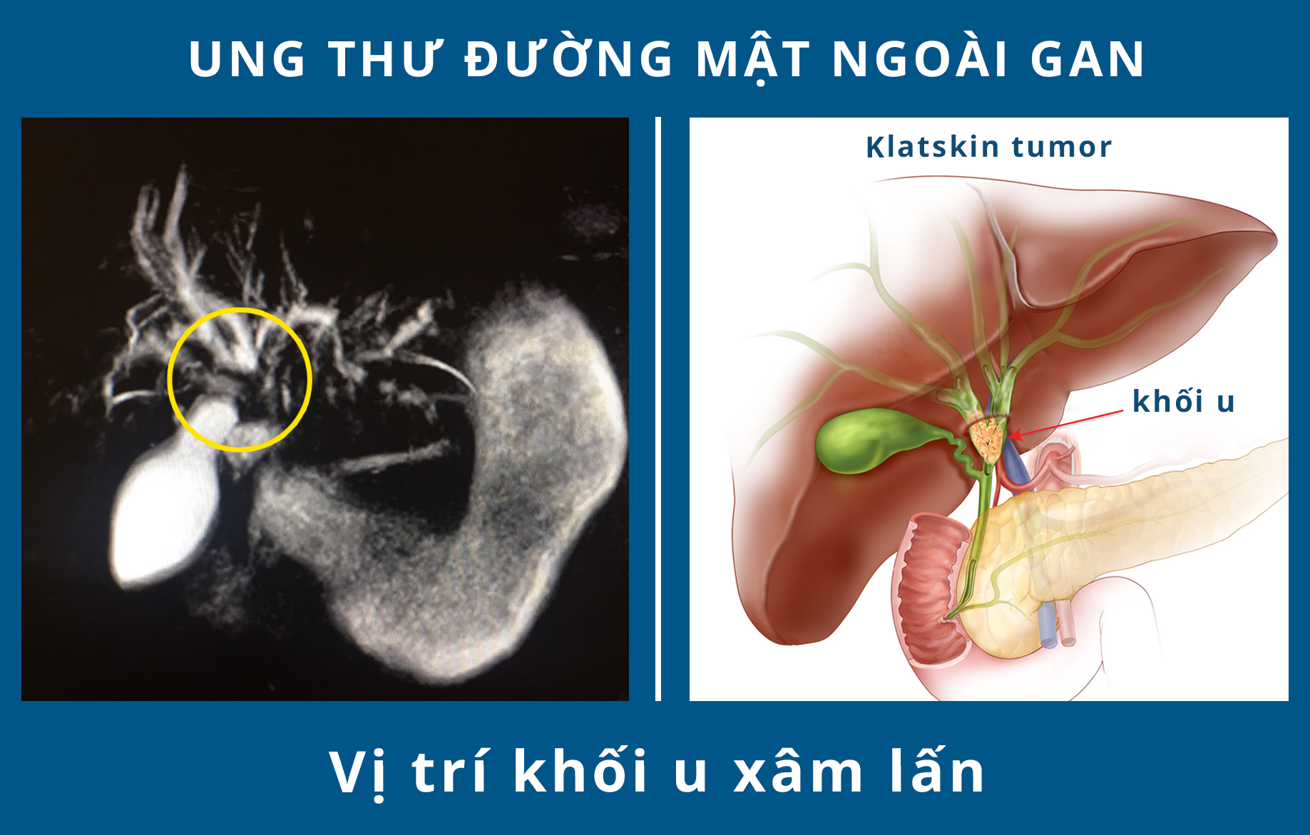 Điều trị sỏi mật, tắc ống mật với chuyên gia ngoại khoa giàu kinh nghiệm