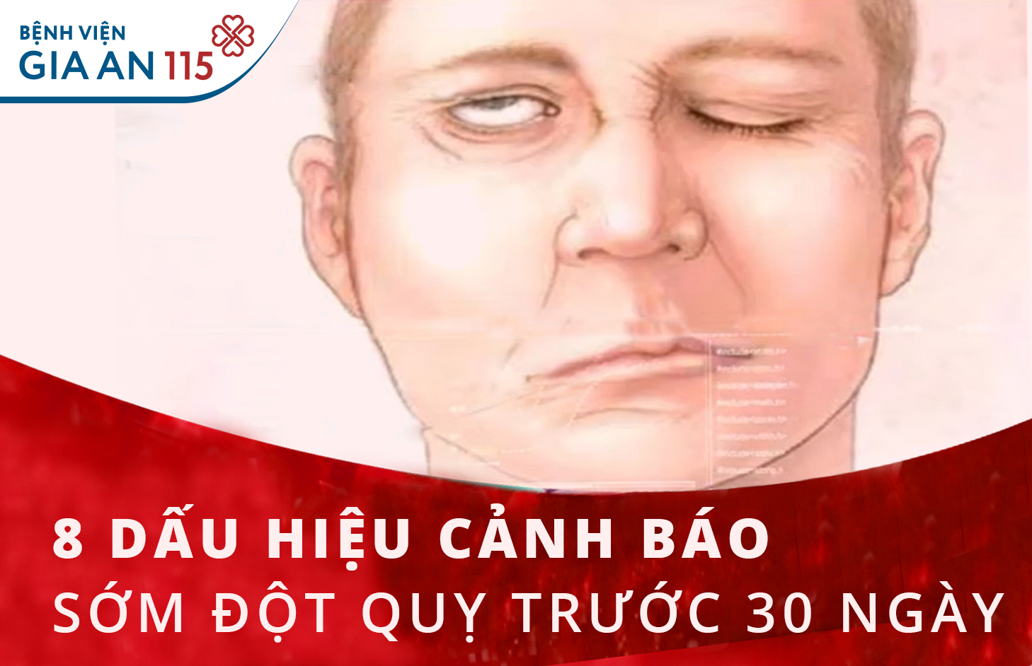 8 dấu hiệu cảnh báo sớm đột quỵ trước 30 ngày