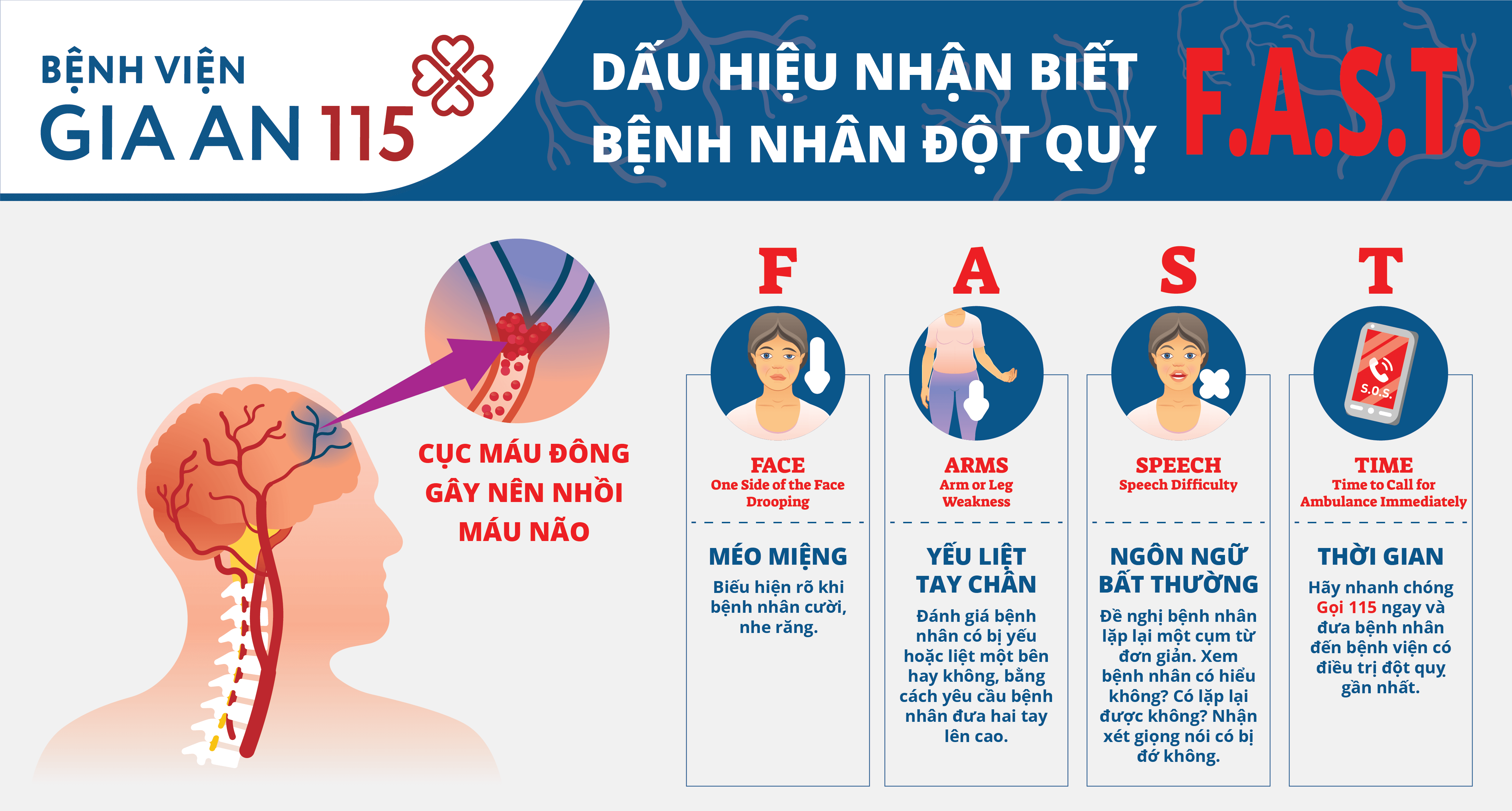 Dấu hiệu nhận biết đột quỵ