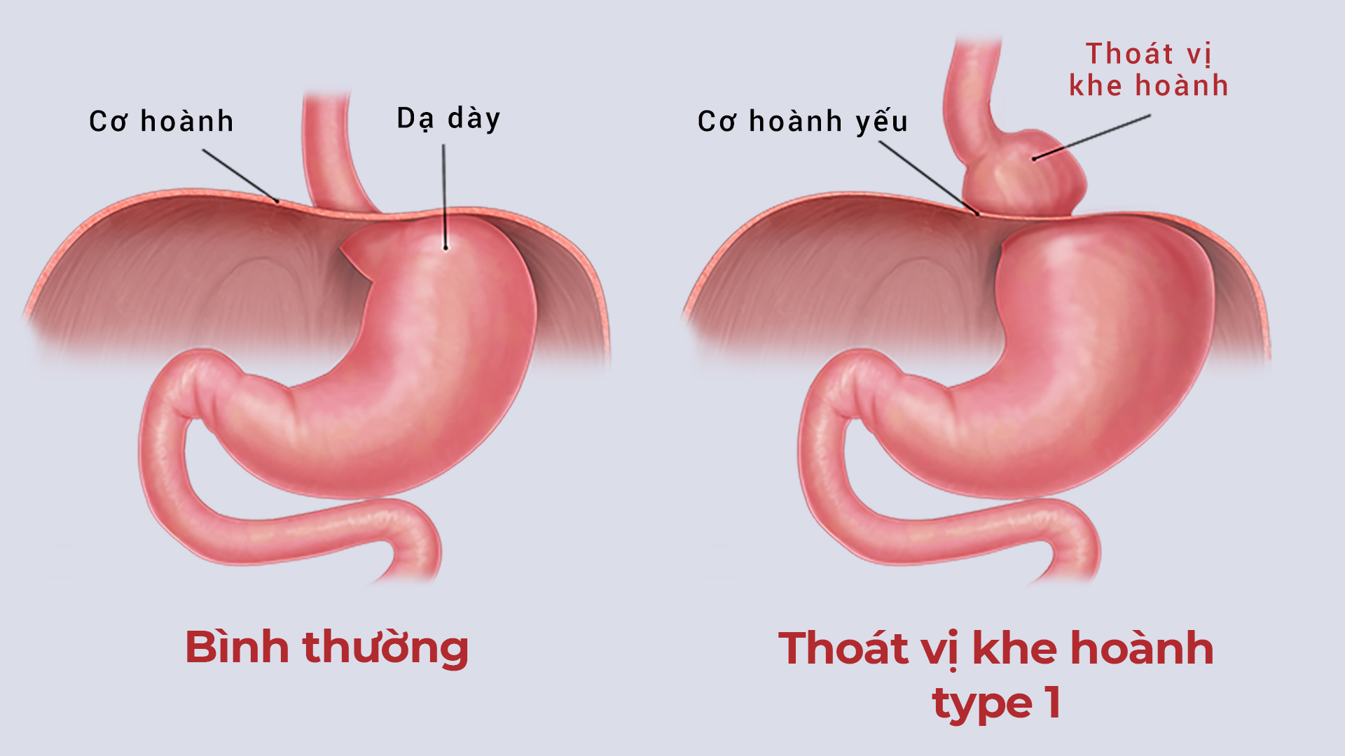 Thoát vị khe hoành bị chẩn đoán nhầm thành suy tim  - Cụ bà suốt 10 năm bị điều trị sai bệnh 