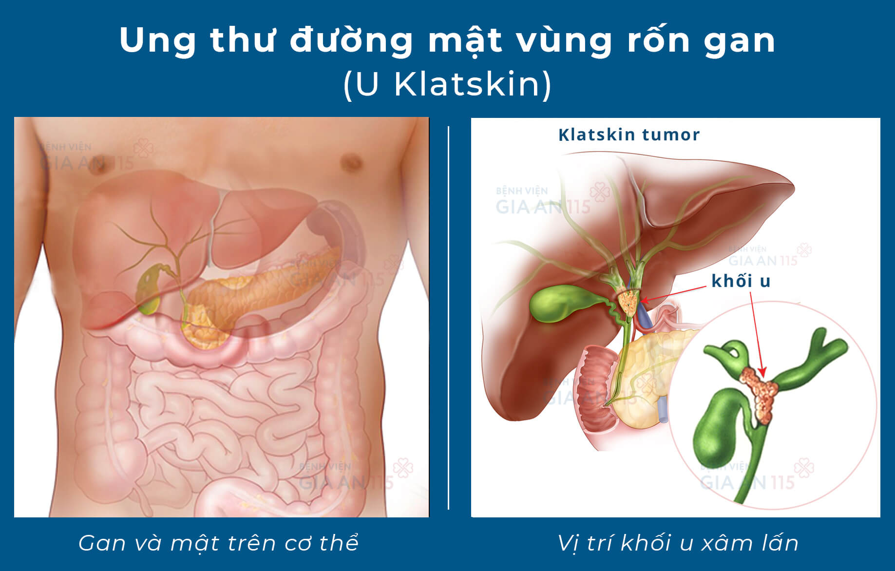 Thông Tin Chi Tiết Về U Rốn Gan