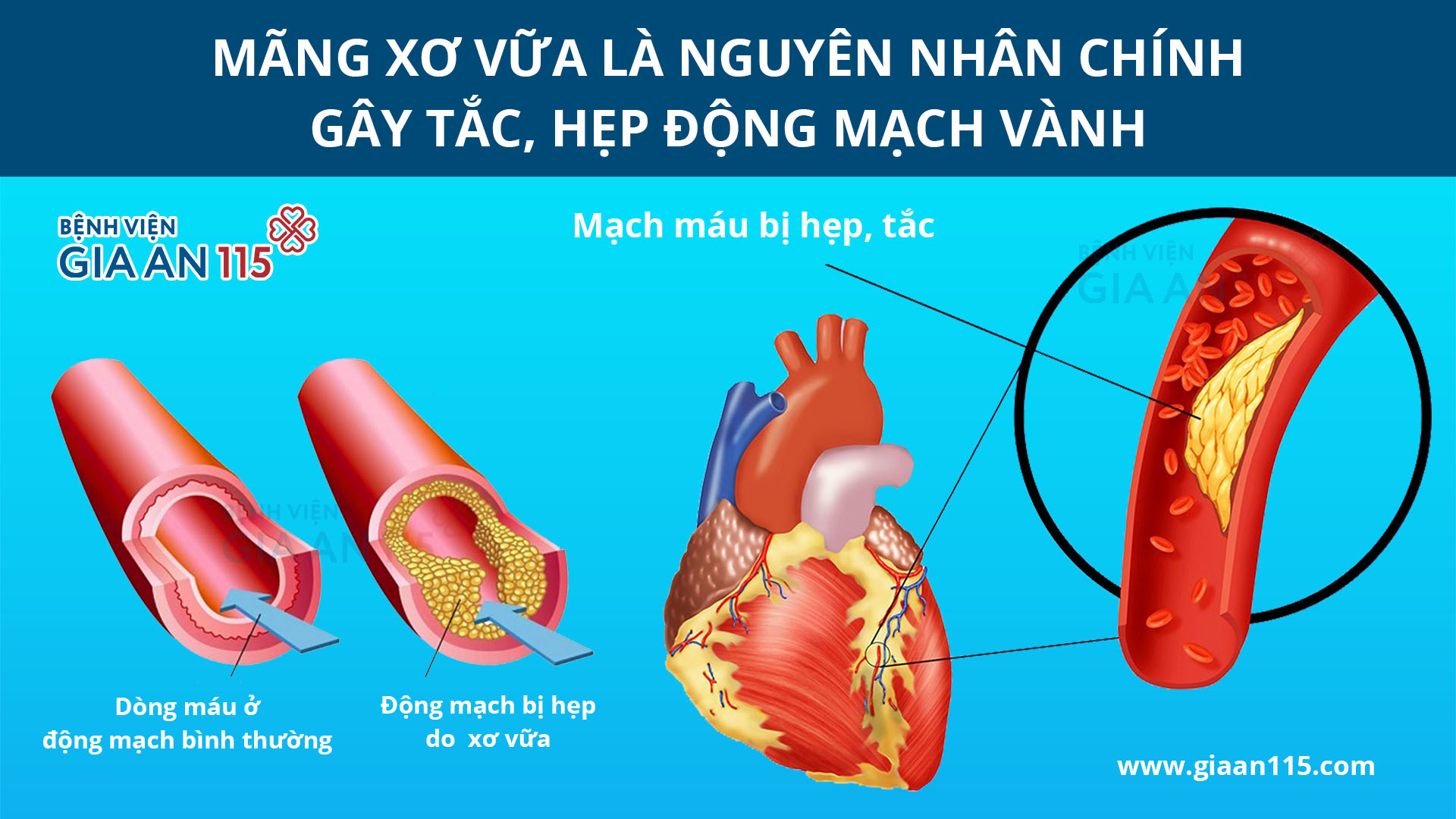 Chăm sóc người bệnh đau thắt ngực