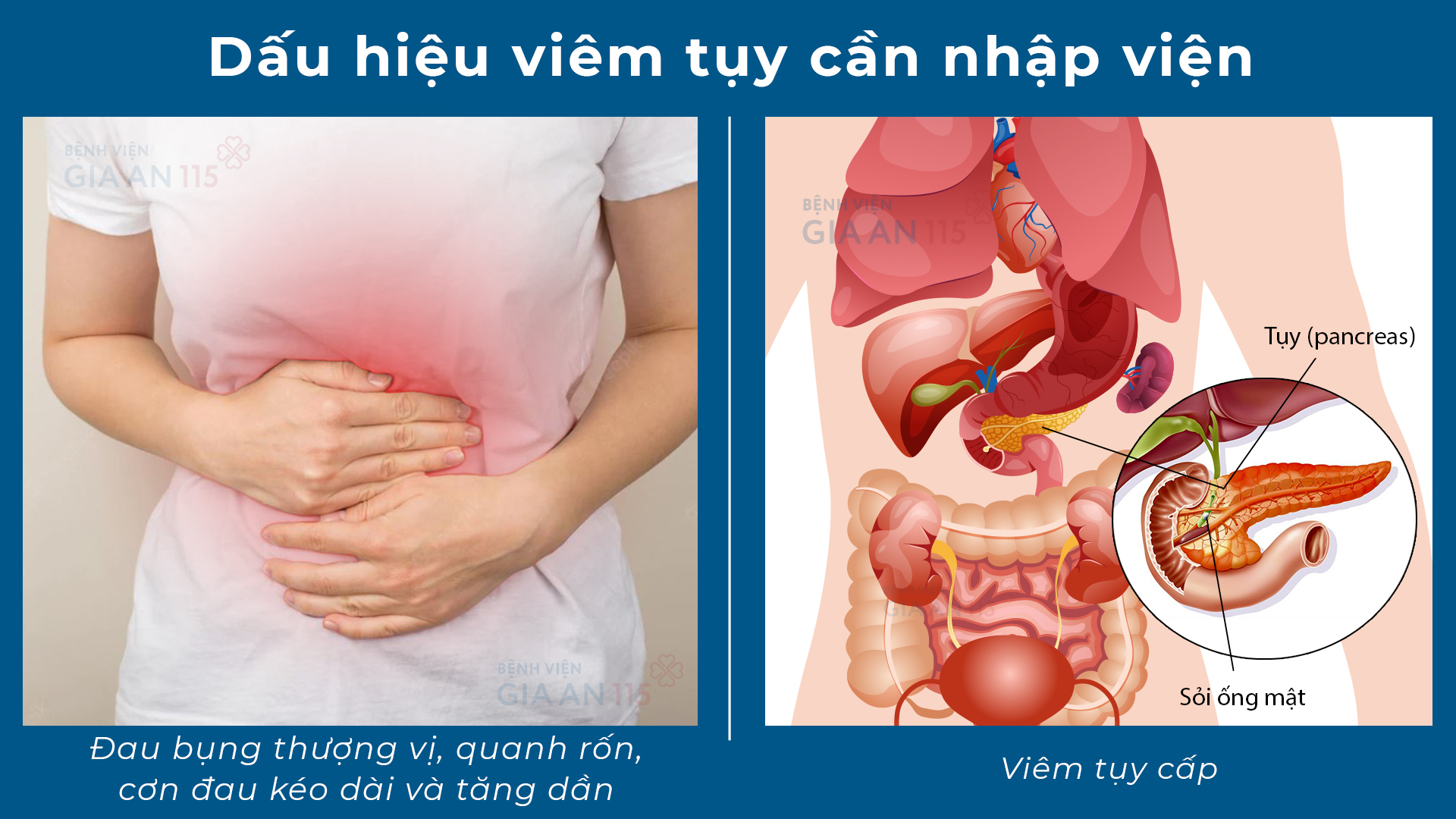 Bệnh viện Gia An 115 khuyến cáo: Cẩn trọng viêm tụy cấp do uống bia rượu dịp lễ