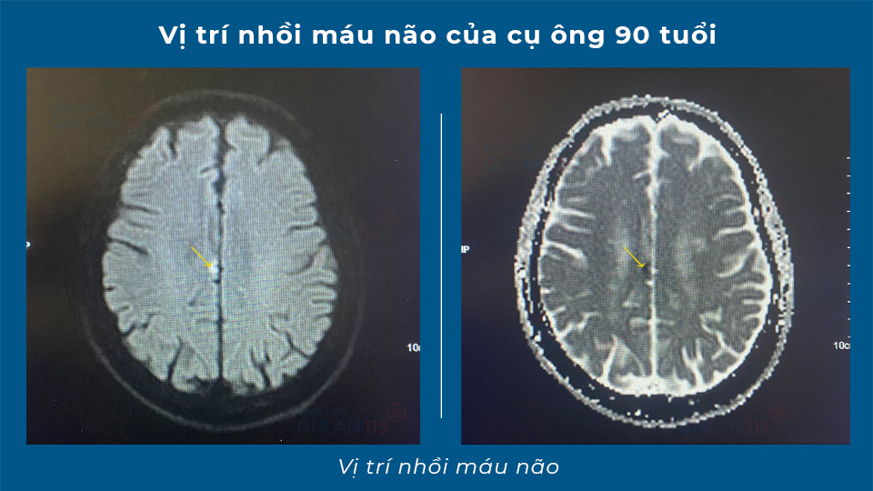 Cụ ông đang tưới cây thì đột ngột liệt nửa người, ngã quỵ