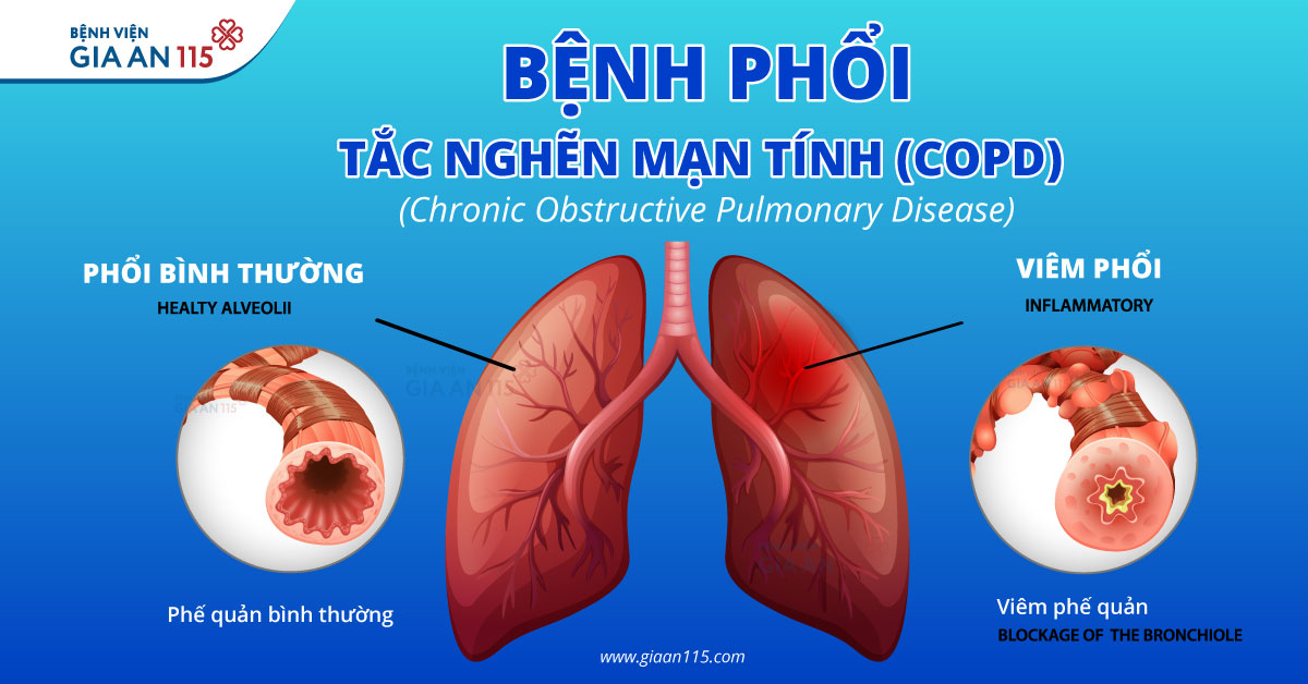 Chăm sóc người bệnh phổi tắc nghẽn mạn tính (COPD)