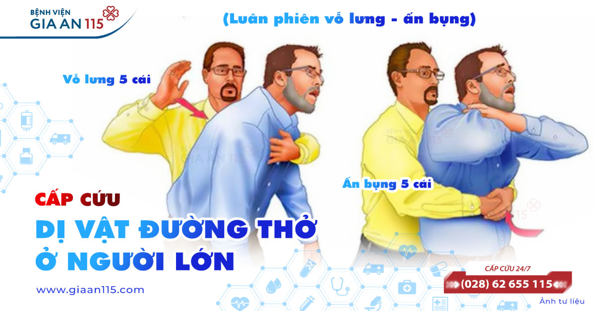 Cấp cứu dị vật đường thở ở người lớn 