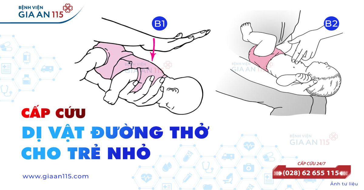 Cấp cứu dị vật đường thở cho trẻ nhỏ 