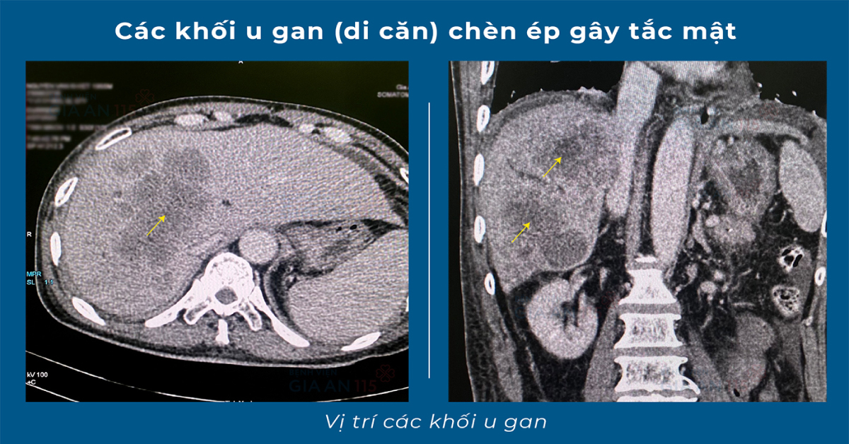 Các khối u gan lớn (di căn) chèn ép gây tắc mật