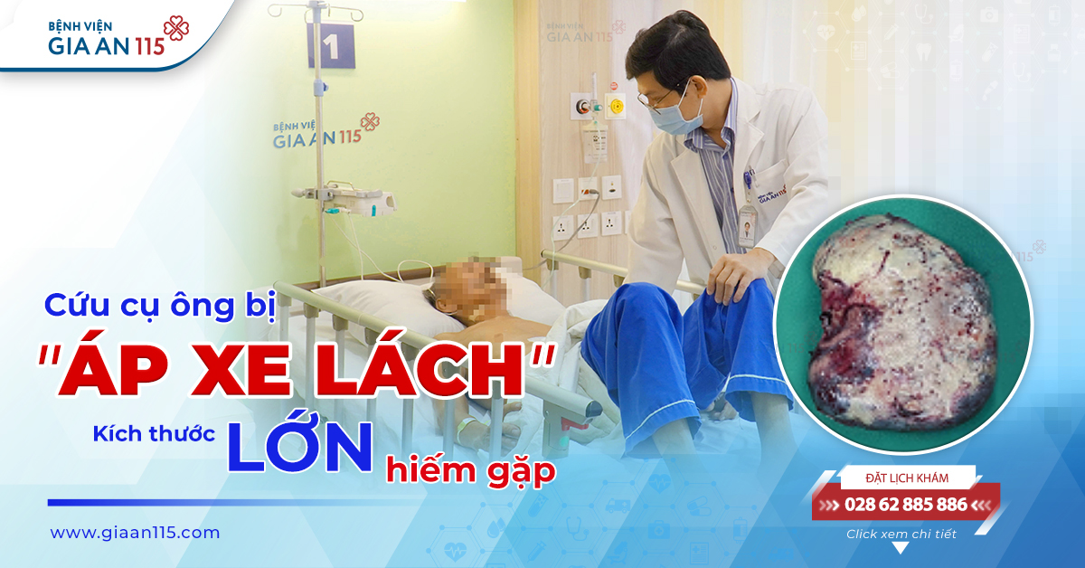 Cứu cụ ông bị áp xe lách kích thước lớn hiếm gặp