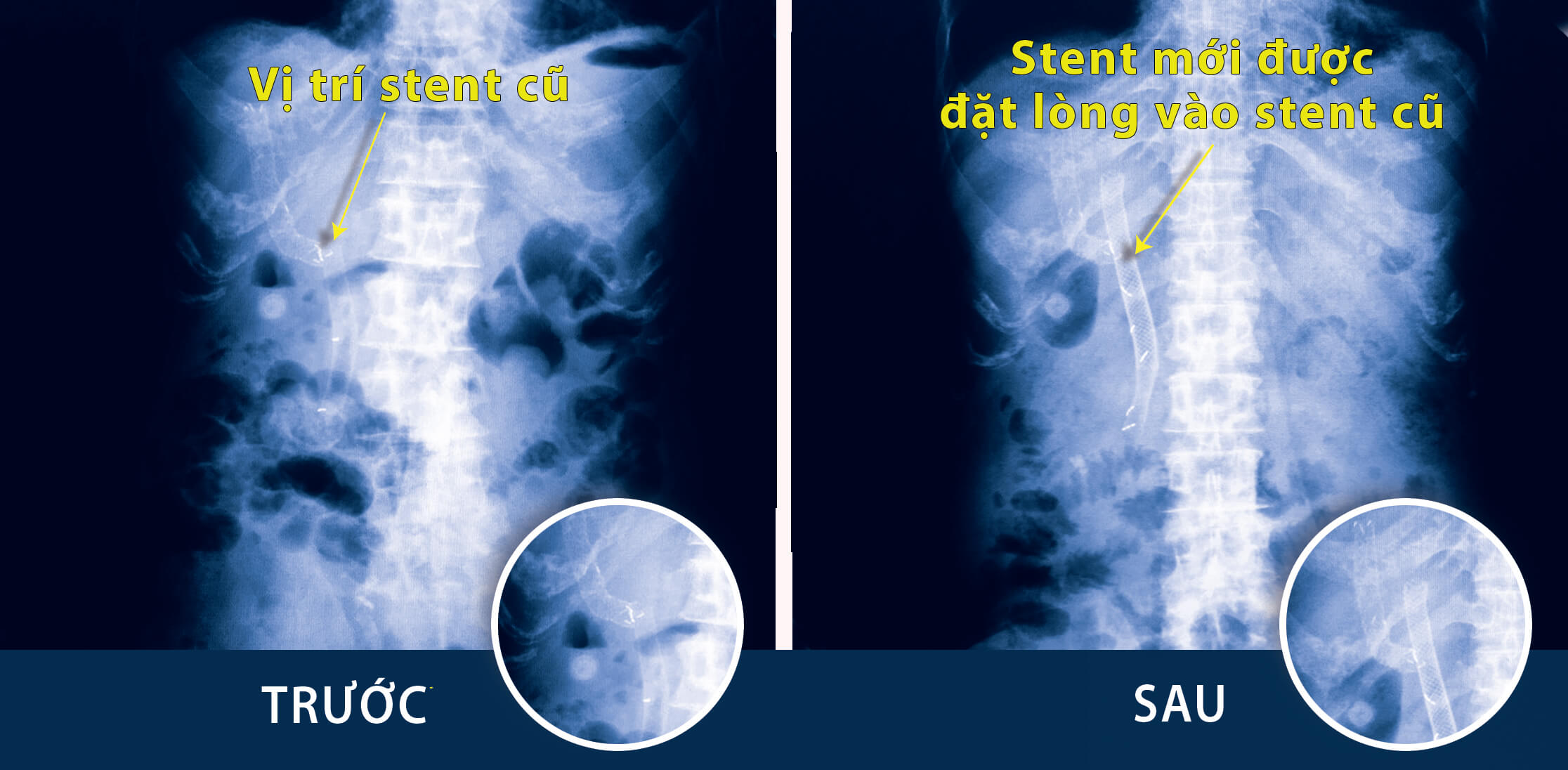 áp dụng kỹ thuật mới, phức tạp là đặt stent trong lòng stent để duy trì sự sống