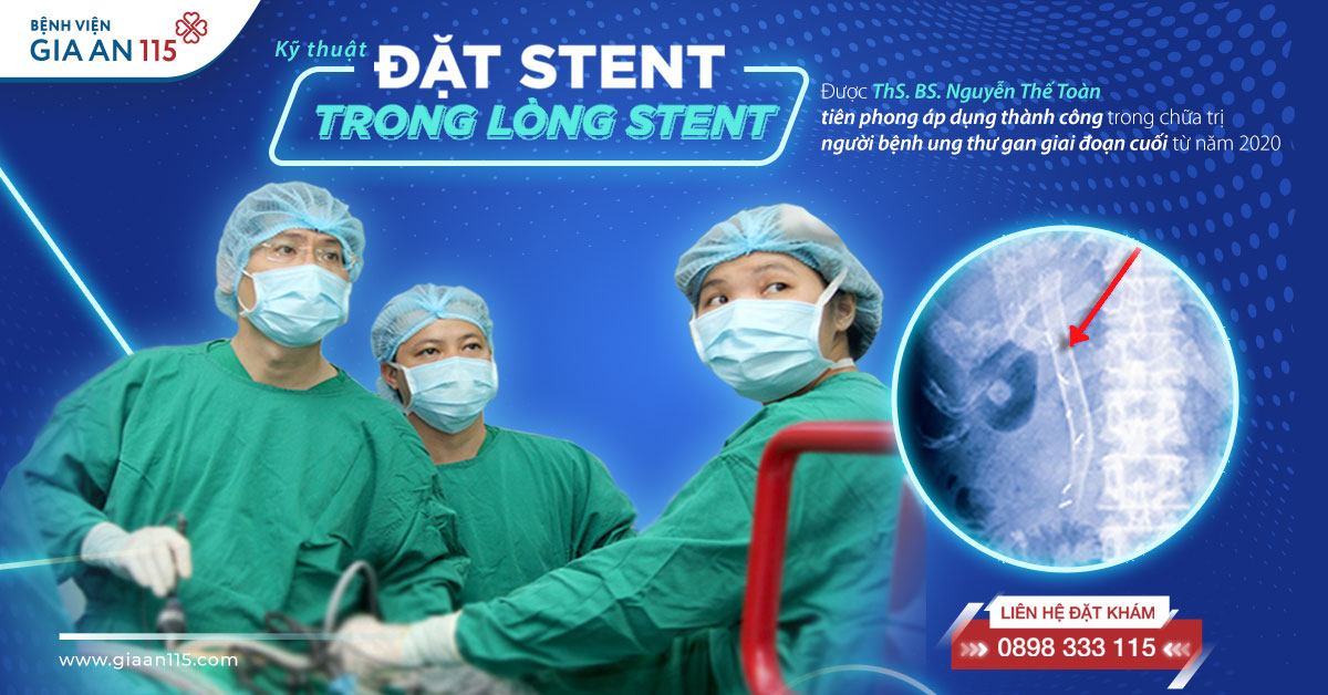 Đặt stent trong lòng stent