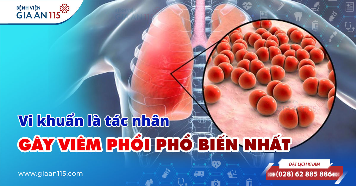 Vi khuẩn là tác nhân gây viêm phổi phổ biến nhất