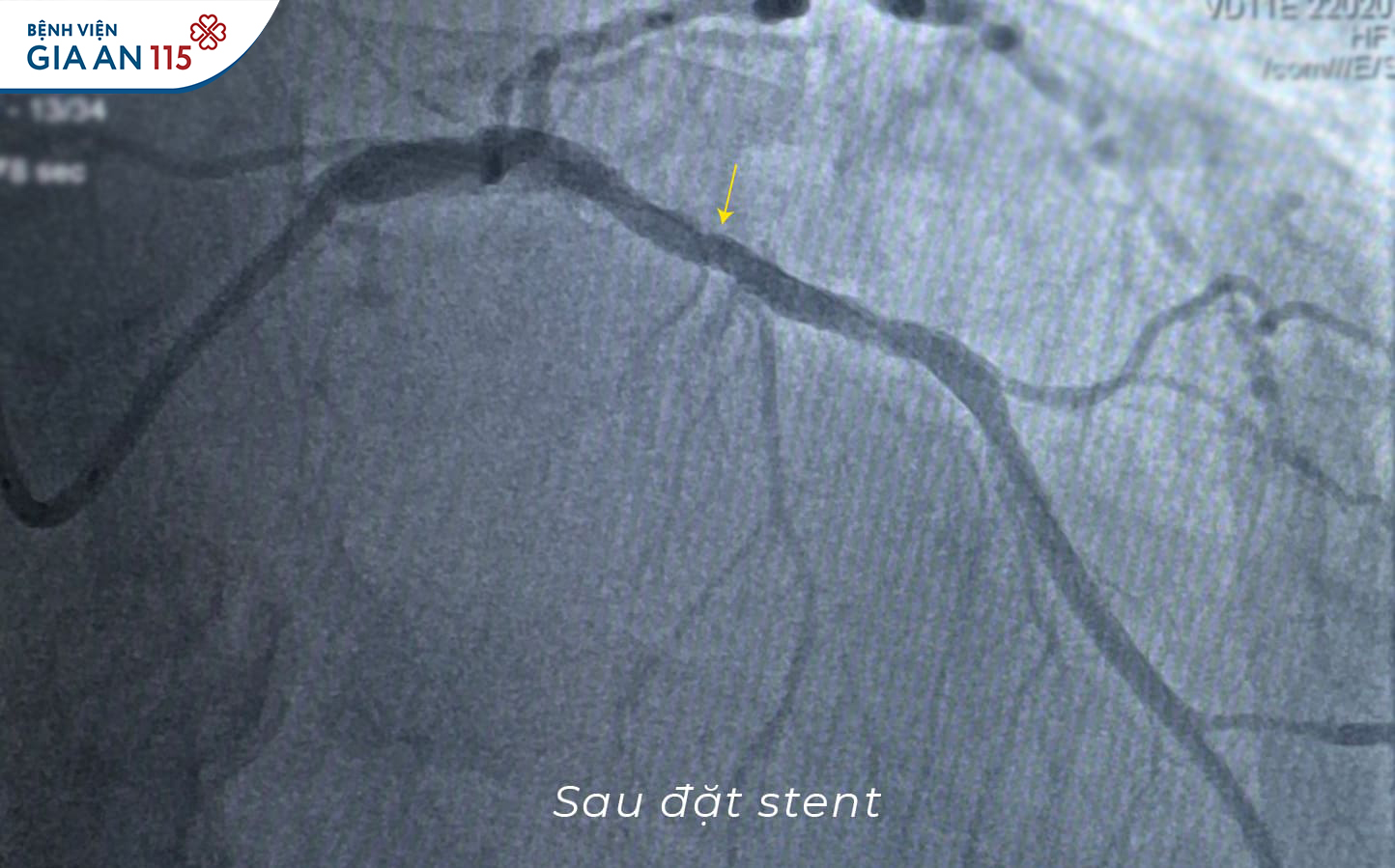 Động mạch vành người bệnh được đặt stent