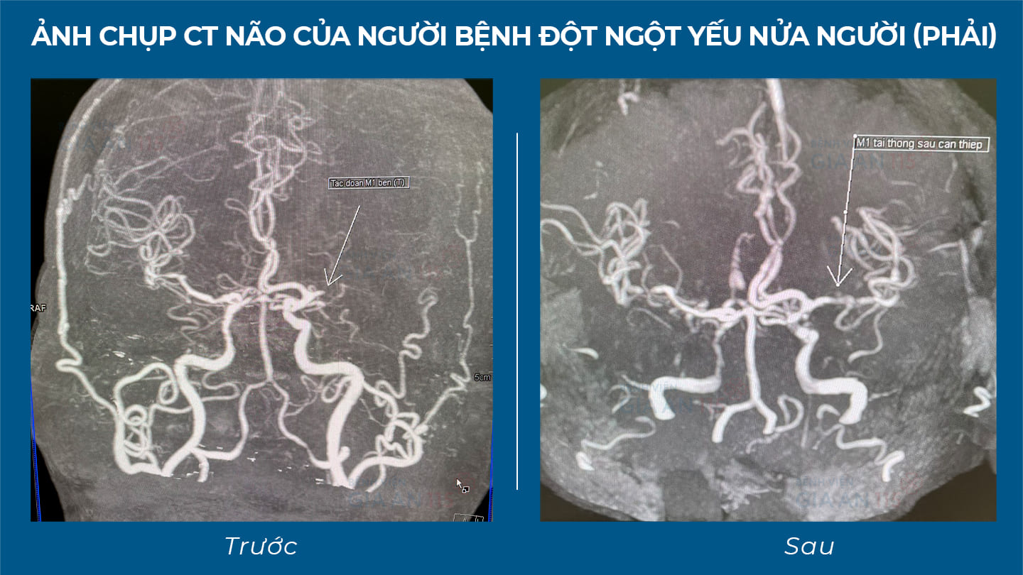 Ảnh chụp CT não của người bệnh đột ngột yếu nửa người (phải)