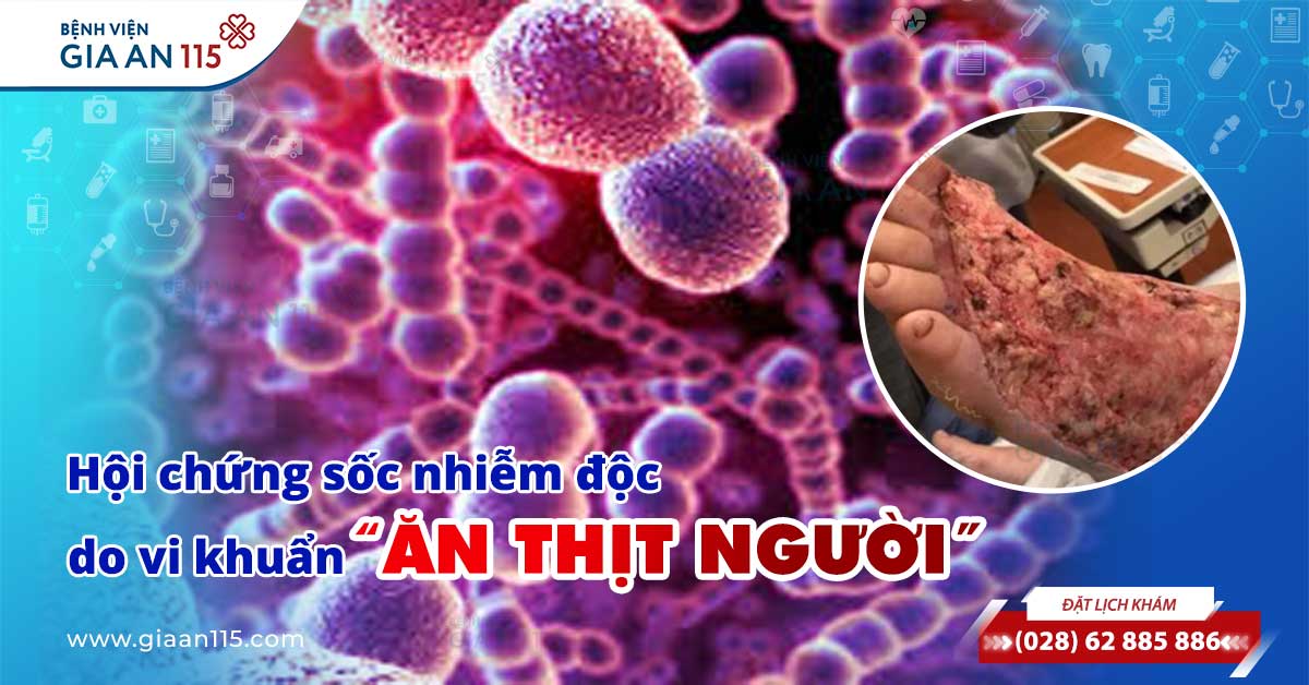 Hội chứng sốc nhiễm độc do vi khuẩn “ăn thịt người”