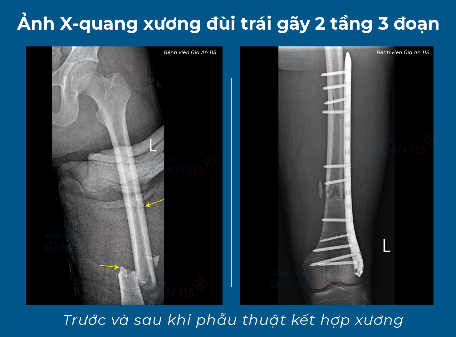 Phẫu thuật cùng lúc 4 vị trí gãy xương cho bệnh nhân đa chấn thương do tai nạn giao thông