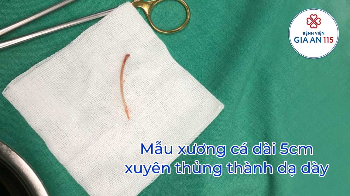 Cảnh báo thủng đường tiêu hóa do xương cá, tăm tre