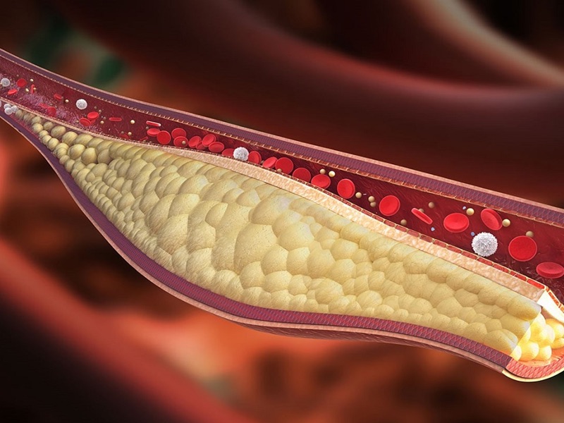 Cholesterol xấu trong máu tăng cao là một trong những nguyên nhân gây xơ vữa động mạch