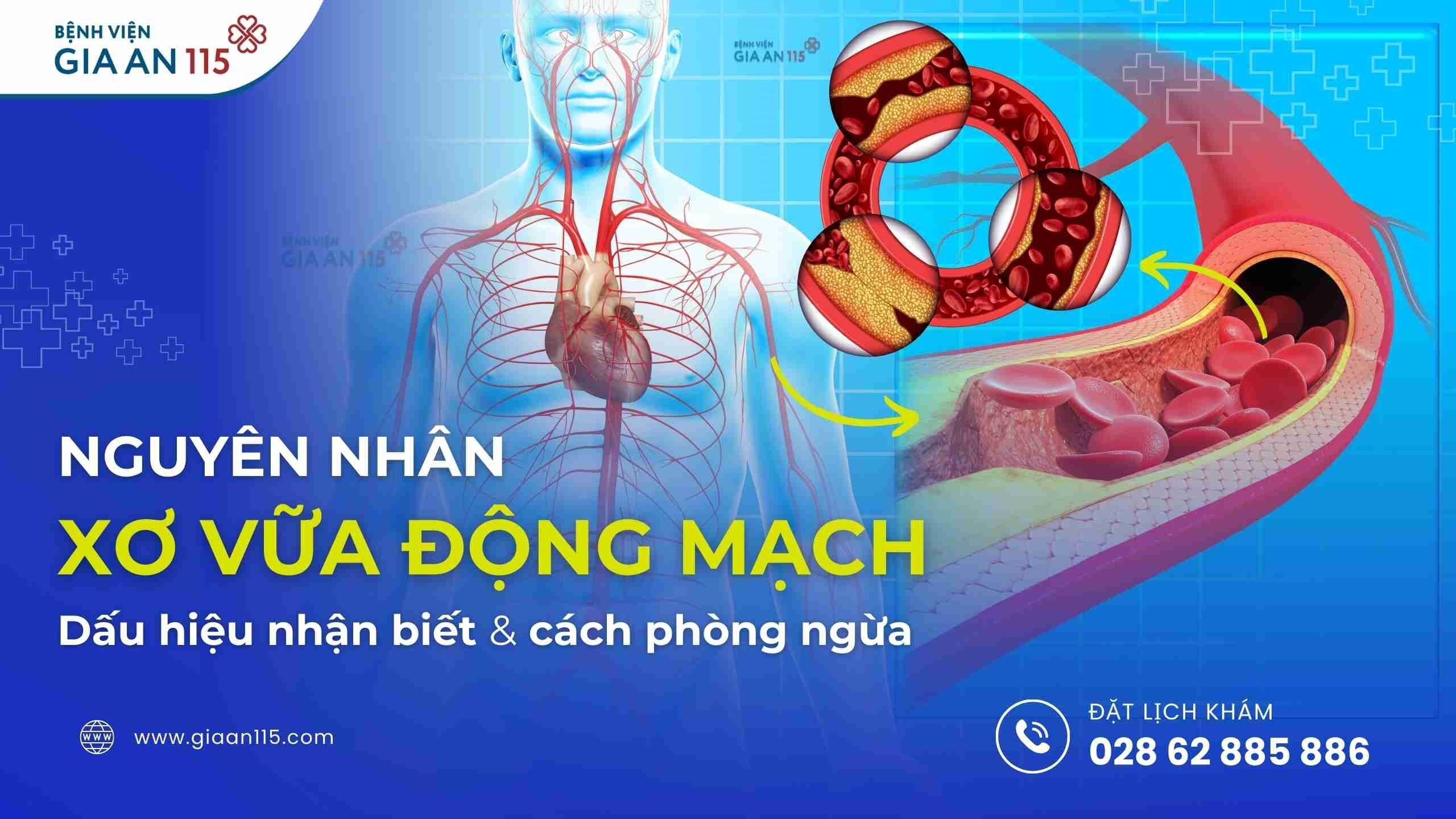 Xơ vữa động mạch là tình trạng xơ hóa thành động mạch