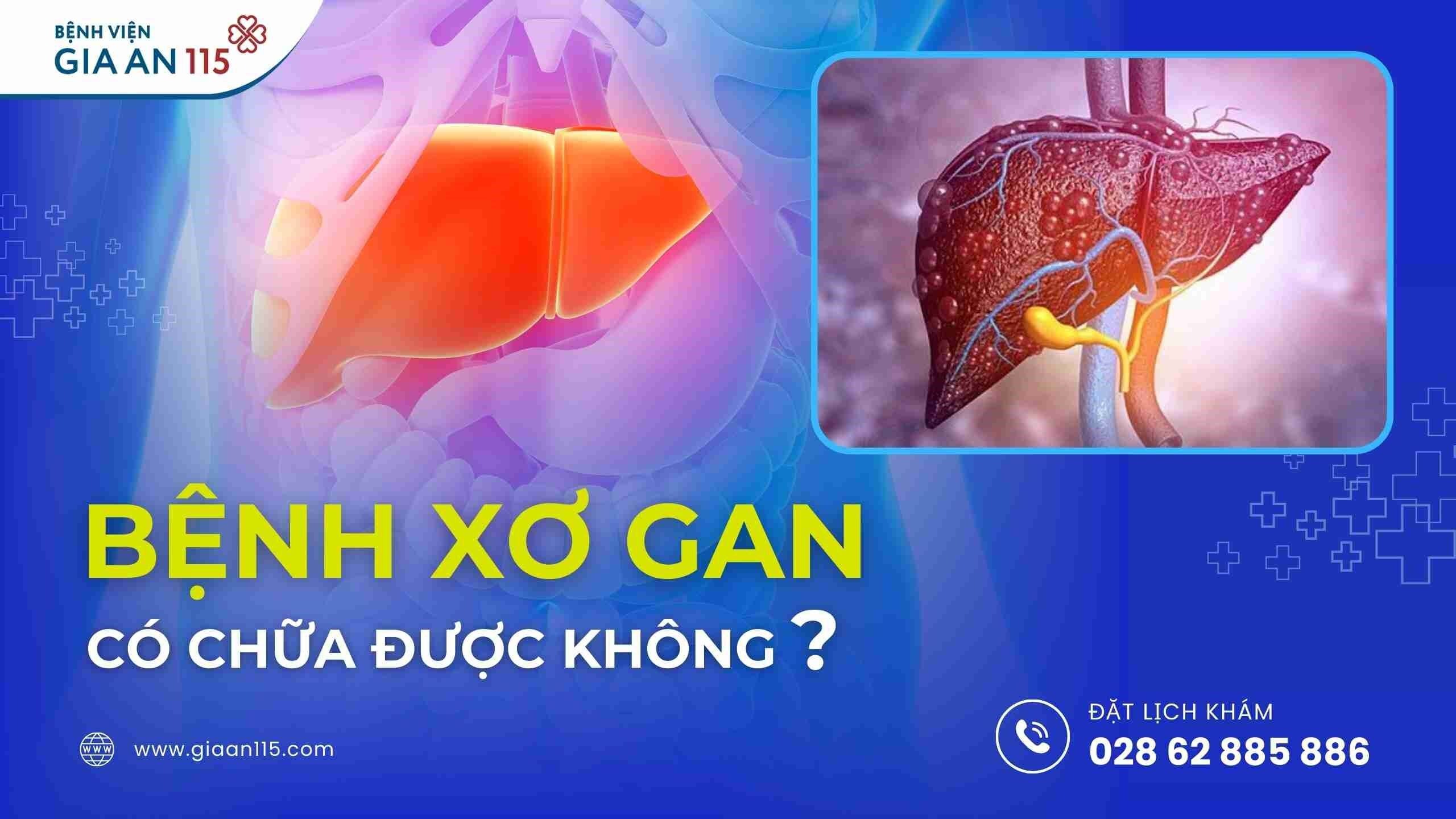 Xơ gan là bệnh lý mà mô sẹo thay thế cho các mô bình thường của nhu mô gan