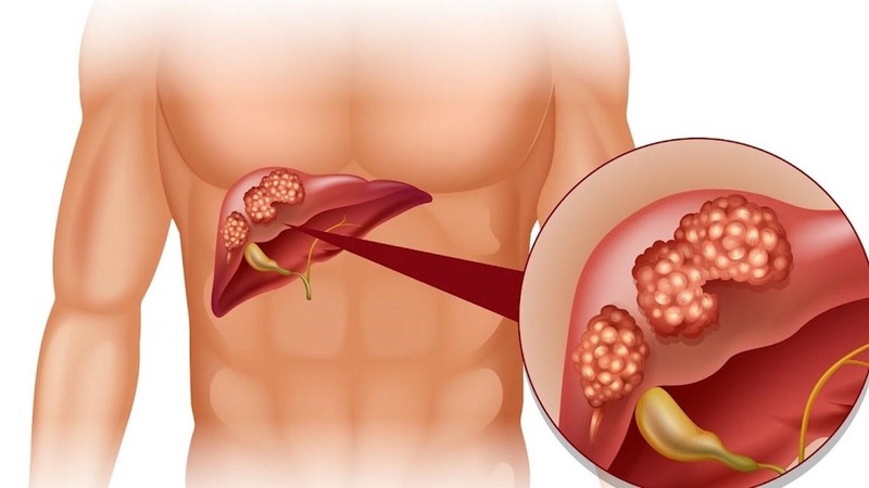 Hình ảnh gan nhiễm mỡ do rượu