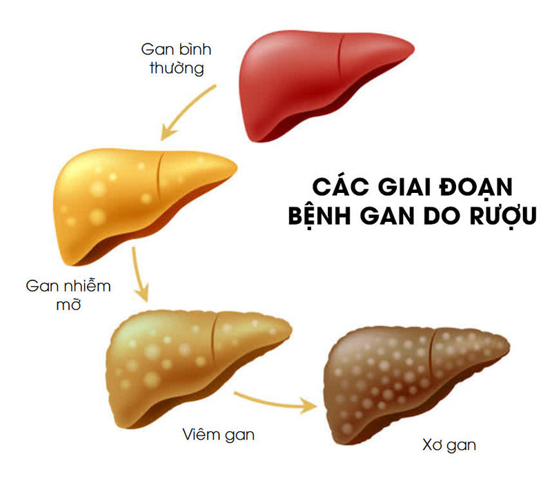 Xơ gan do rượu