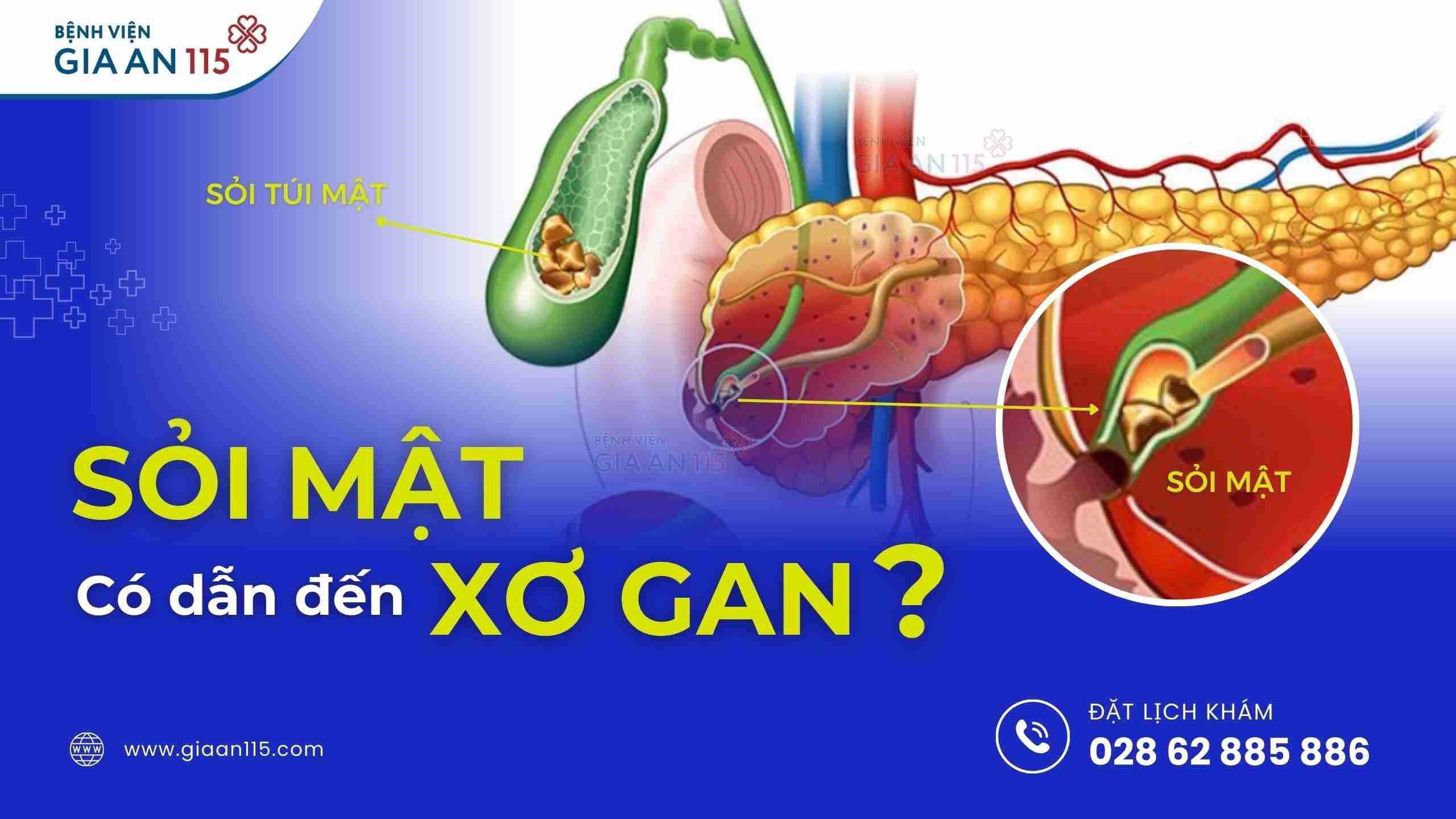 Sỏi mật có dẫn đến xơ gan không?