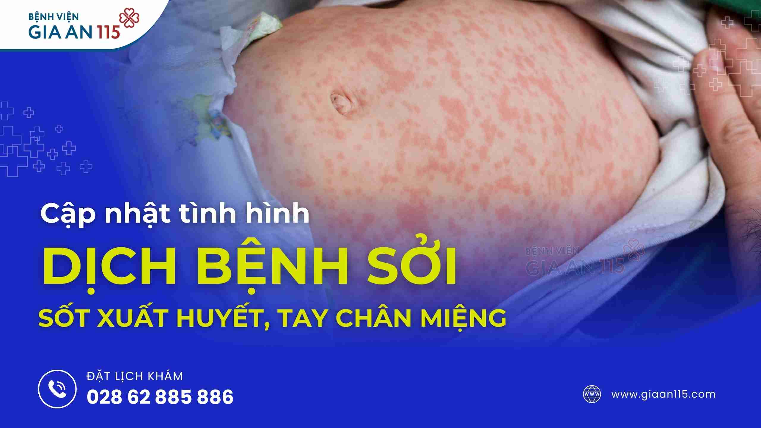 Cập nhật tình hình dịch bệnh sởi, sốt xuất huyết, tay chân miệng 