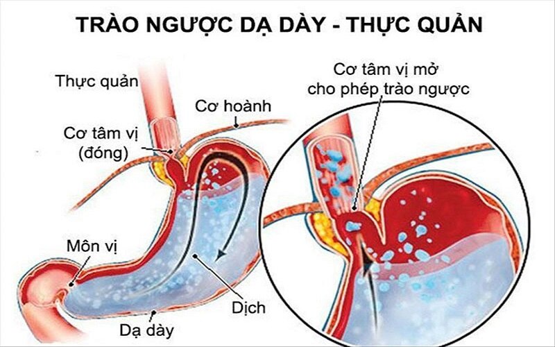 5+ triệu chứng trào ngược dạ dày thực quản bạn nên biết