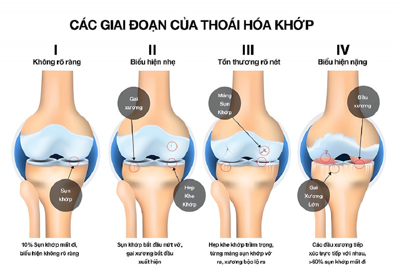 Độ 4 có mức độ nặng và dễ gây biến chứng