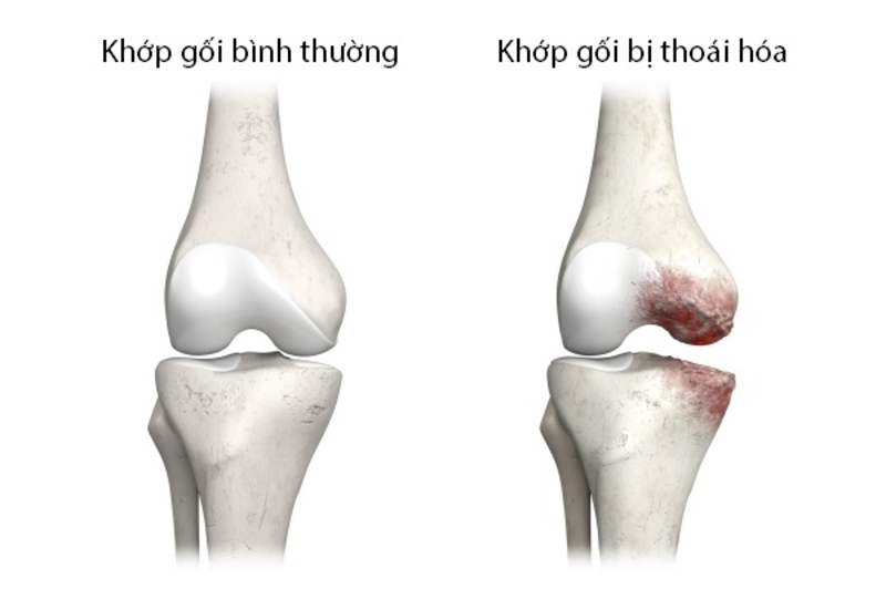 Thoái hóa khớp gối có mấy độ? Cách nhận biết và phòng ngừa