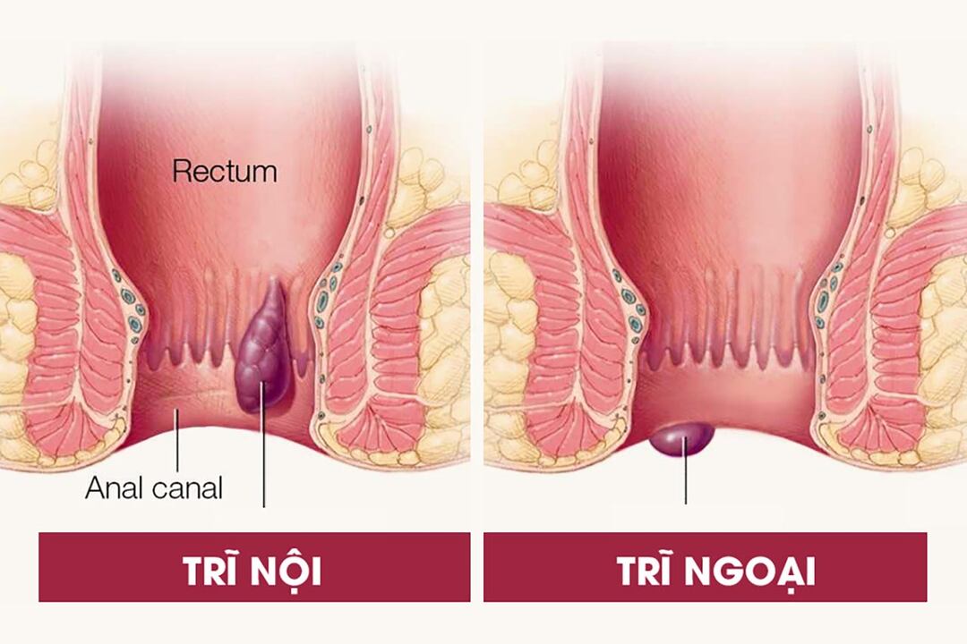 Hình ảnh phân biệt trĩ nội và trĩ ngoại