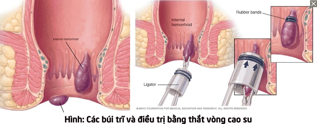 Trĩ nội có chữa được không? - Phương pháp thắt vòng cao su chi phí thấp