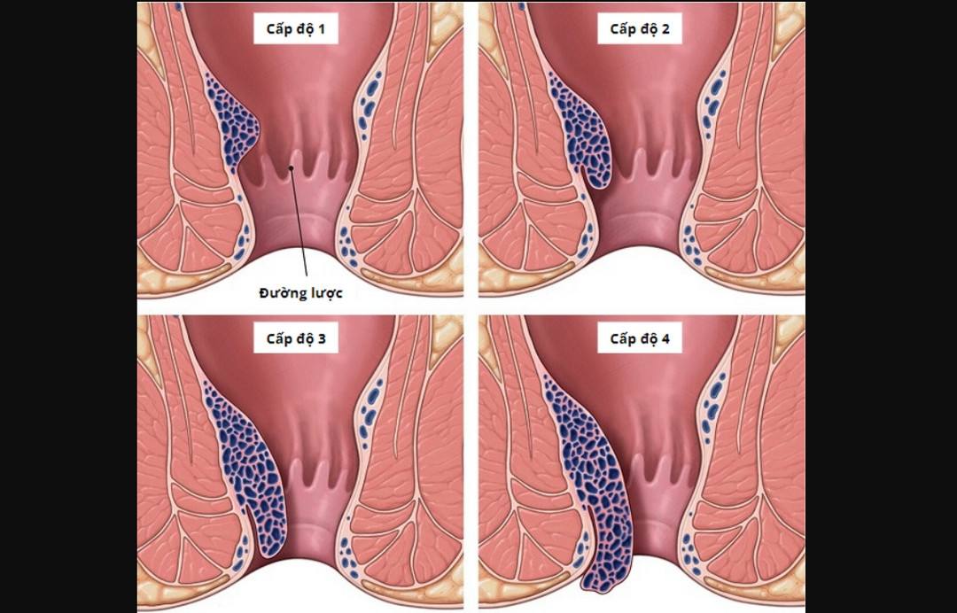 Bệnh trĩ có mấy loại, cách phân biệt và điều trị hiệu quả