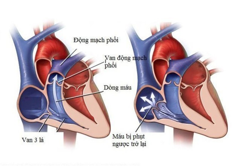 Hở van 3 lá 1/4 có chữa được không? Giải đáp chi tiết