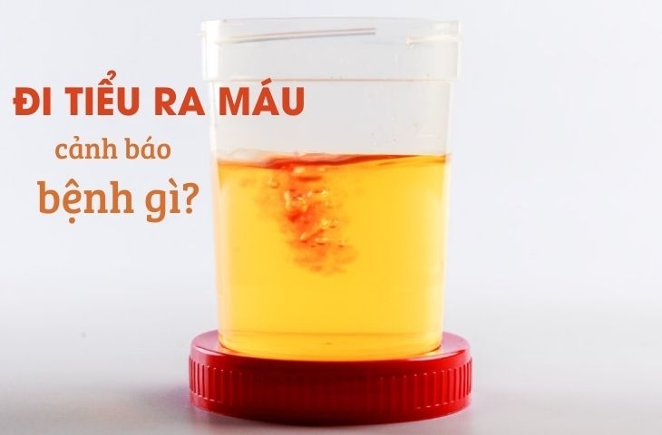 Màu nước tiểu của người bị tiểu đường khi gặp biến chứng nhiễm trùng tiết niệu