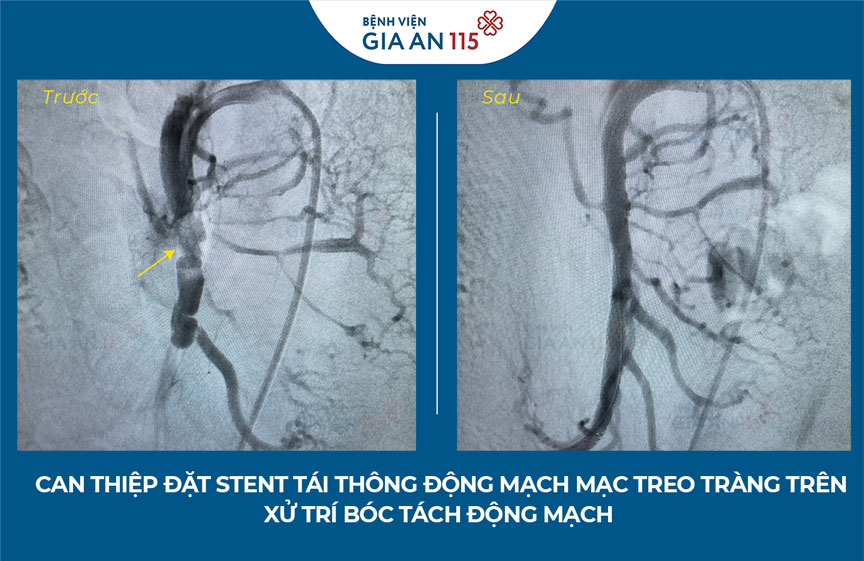 Đau bụng sau ăn, không ngờ bị bóc tách động mạch mạc treo tràng trên hiếm gặp nguy hiểm tính mạng