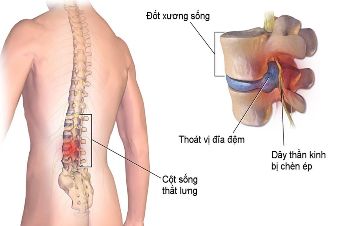 Hình ảnh bệnh lý thoái hóa cột sống