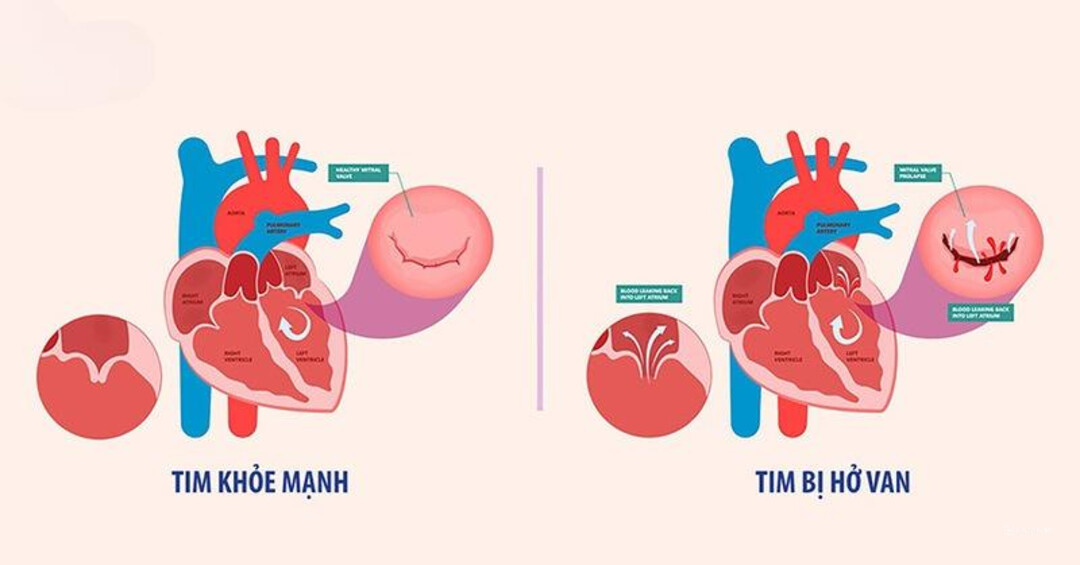 Bị hở van tim có nguy hiểm không? Điều trị ở bệnh viện nào uy tín?