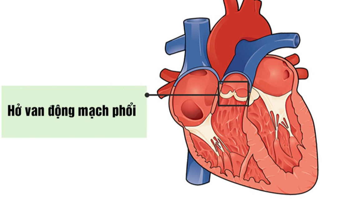 Hình ảnh hở van động mạch phổi