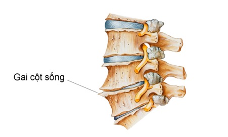 Hình ảnh gai cột sống ở người bệnh